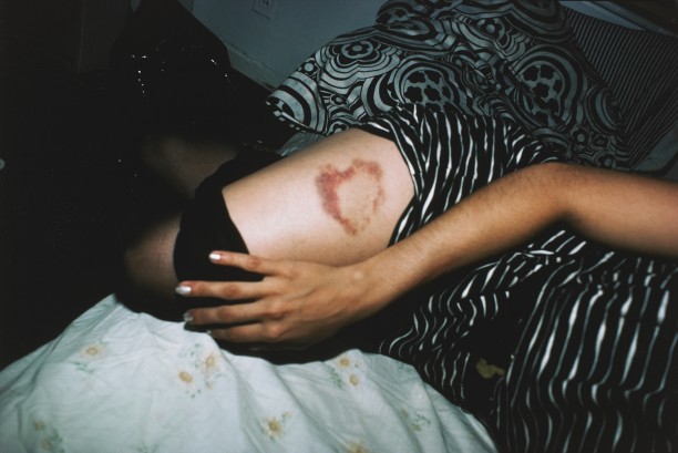 Heart-shaped bruise, New York City